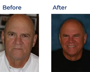 The image shows a before-and-after comparison of a man's face, with the