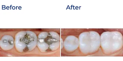 Before and after comparison of teeth showing replacement of metal fillings with tooth-colored restorations