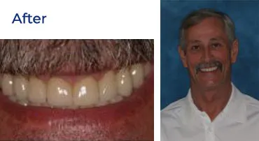 A close-up of a man's smile after a dental procedure, showing a full set of teeth.