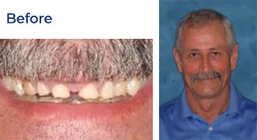 A before-and-after image showing a man's teeth before a dental procedure.