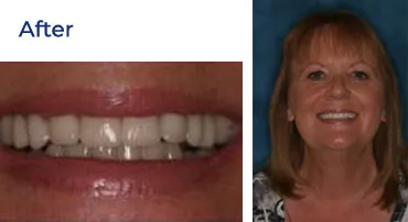 A close-up of a woman's smile after a dental procedure, showing a complete set of teeth.