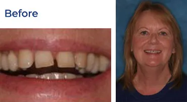 A close-up of a woman's smile before a dental procedure, showing a complete set of teeth.