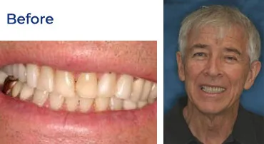A before-and-after image shows a man's teeth before a dental procedure resulting in some misalignment and discoloration.