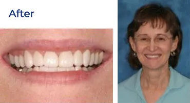 A close-up of a woman's smile after a dental procedure, showing straighter and whiter teeth.