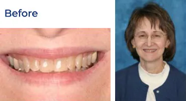 A before-and-after image showing a woman's teeth before and after a dental procedure.